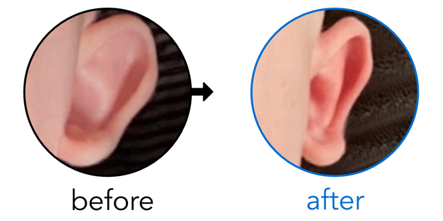 Before-and-after EarBuddies Stick-Out Ears result; started at 1–3 months – Jessica A