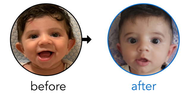 Before-and-after EarBuddies Stick-Out Ears result; started at 1–3 months – Sahar & her Son