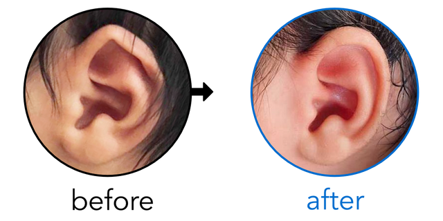 Before-and-after EarBuddies Folded-Over Helical Rim result; started within the first month – Teresa & her Son