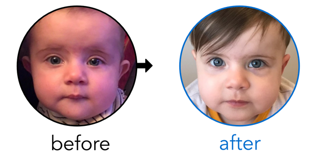 Before-and-after EarBuddies Stick-Out Ears result; started at 6–12 months – Jennifer, Luke & their Daughter Eloise