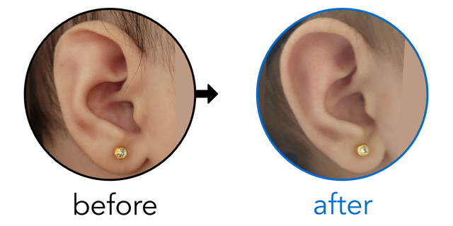 Before-and-after EarBuddies Stahl's Bar result; started at 1–3 months – Anas & her Daughter Maya