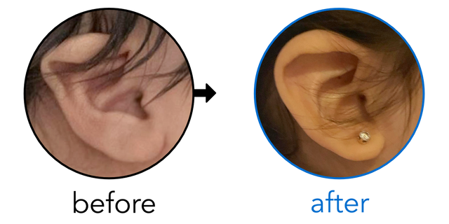 Before-and-after EarBuddies Lop Ear result; started at 1–3 months – Mrs. B & her Daughter