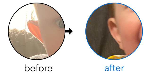 Before-and-after EarBuddies Stick-Out Ears result; started at 3–6 months – Luise & her son Tallan