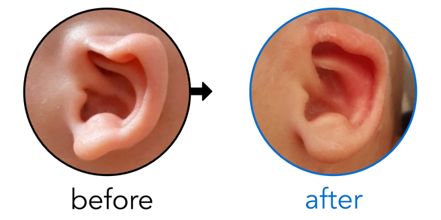 Before-and-after EarBuddies Rim Kink result; started at 3–6 months – Gabriela & her son