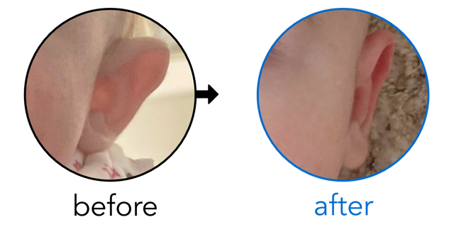 Before-and-after EarBuddies Stick-Out Ears result; started at 3–6 months – Zoe Luscombe