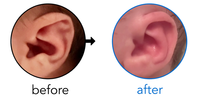 Before-and-after EarBuddies Stahl's Bar result; started at 1–3 months – Laurel & her baby