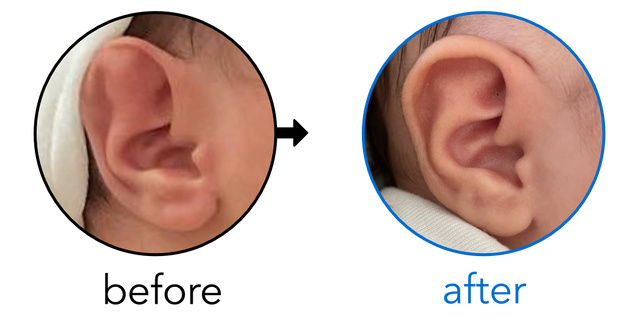 Before-and-after EarBuddies Stahl's Bar result; started at 1–3 months – Diana & her daughter