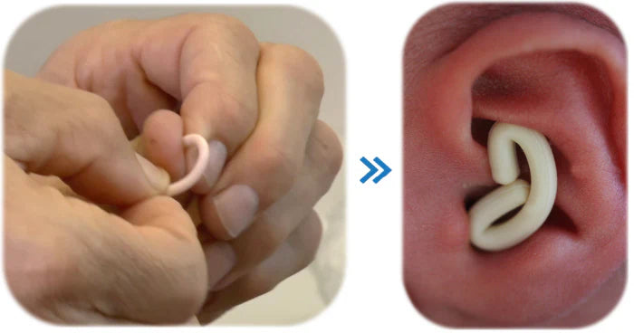 Ear Splints Baby Fitting guide – EarBuddies