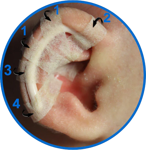 Ear Splints Baby Fitting guide – EarBuddies