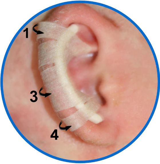 Ear Splints Baby Fitting guide – EarBuddies