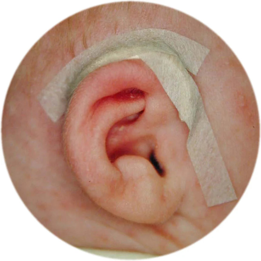 Ear Splinter Fitting guide – EarBuddies