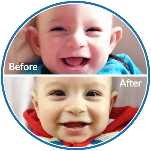 Ear Splints Baby EarBuddies | Permanent Solution to Stick-Out Ears & Ear Deformities