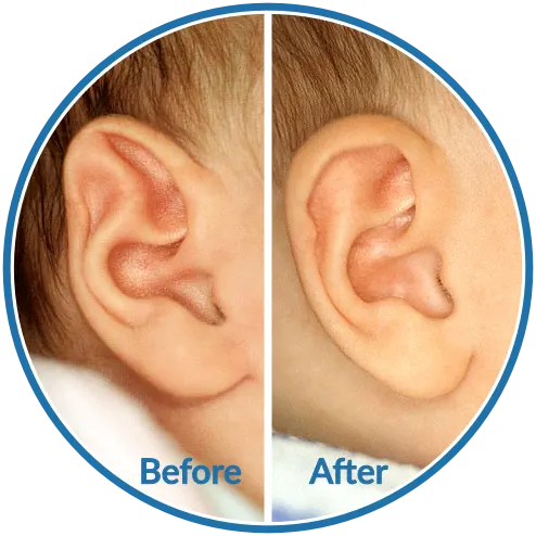 Ear Splints Baby EarBuddies | Permanent Solution to Stick-Out Ears & Ear Deformities
