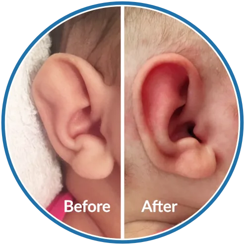 Ear Splints Baby EarBuddies | Permanent Solution to Stick-Out Ears & Ear Deformities