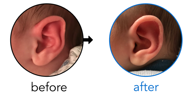 Before-and-after EarBuddies Folded-Over Helical Rim result; started at 1–3 months – Alyssa & her Son Marco