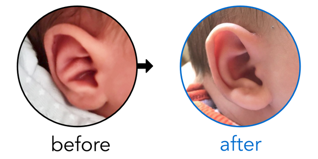 Before-and-after EarBuddies Conchal Crus result; started within the first month – Georgette & her son Alexis