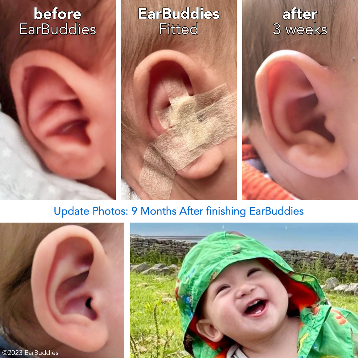 Babys Ears starting to Stick Out or Fold Over? EarBuddies™