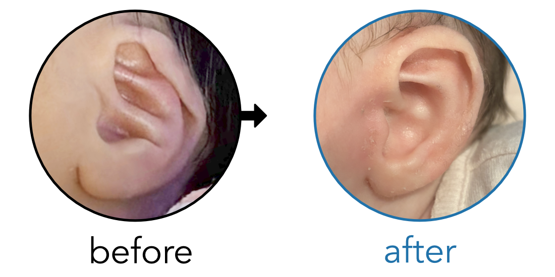 Before-and-after EarBuddies Conchal Crus result; started within the first month – Alyssa & her daughter