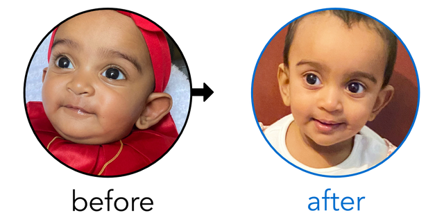 Before-and-after EarBuddies Stick-Out Ears result; started at 3–6 months – Mrs S. & her Daughter Baby H