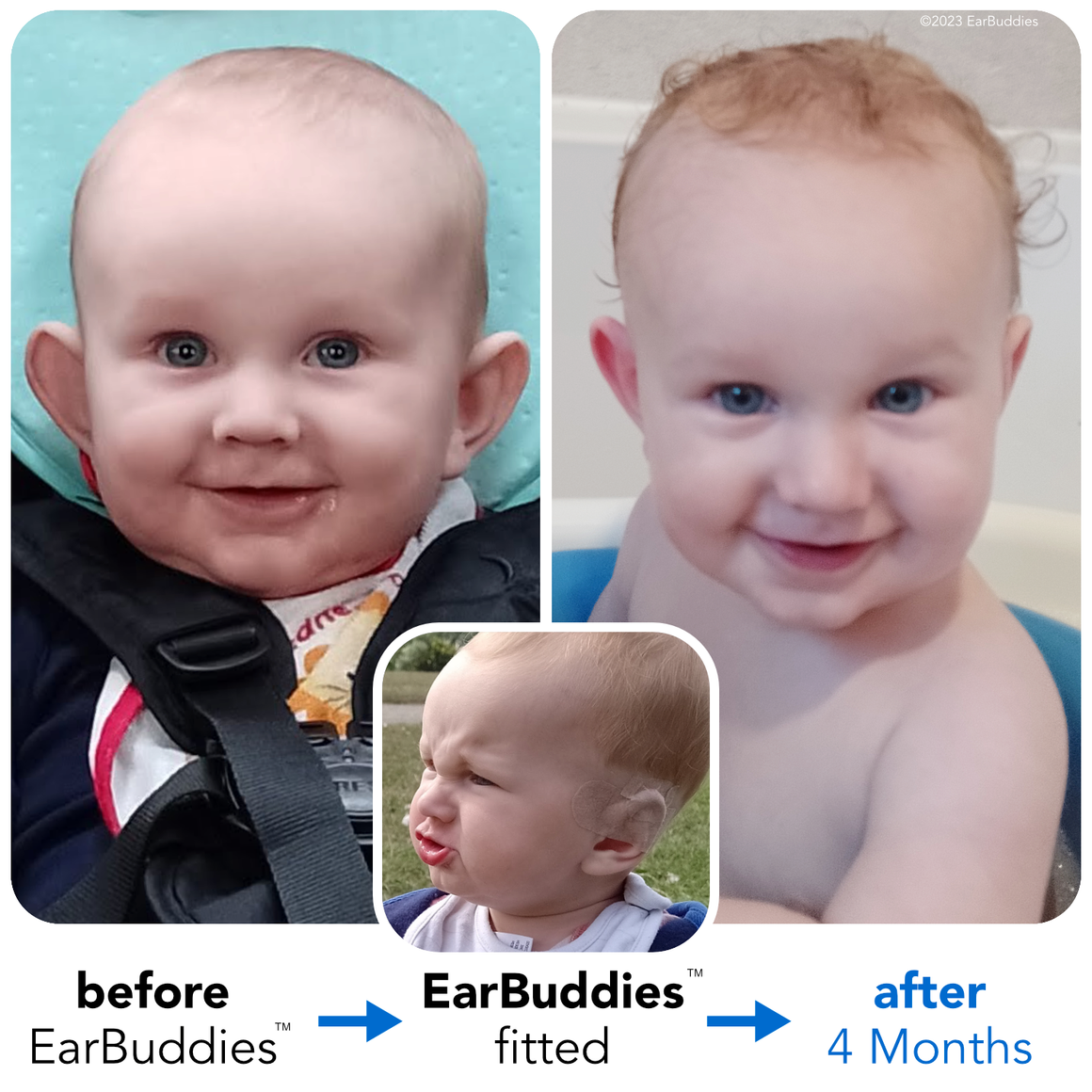 Babys Ears starting to Stick Out or Fold Over? EarBuddies™