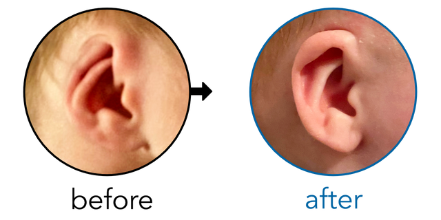 Before-and-after EarBuddies Cryptotia result; started at 1–3 months – Charlotte & her son