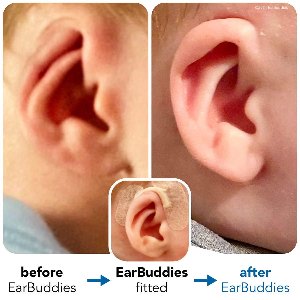 Ear Splints Baby EarBuddies | Permanent Solution to Stick-Out Ears & Ear Deformities
