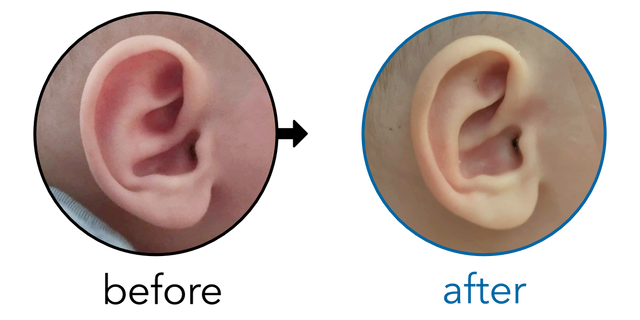Before-and-after EarBuddies Conchal Crus result; started at 3–6 months – Diana & her daughter Dara