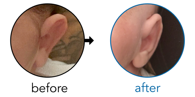 Before-and-after EarBuddies Stick-Out Ears result; started within the first month – Sam & his son