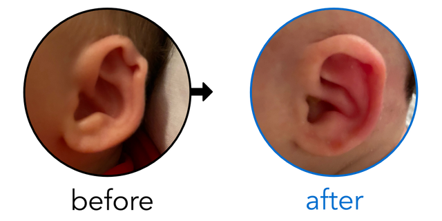 Before-and-after EarBuddies Rim Kink result; started within the first month – Sydney & her Daughter Ava