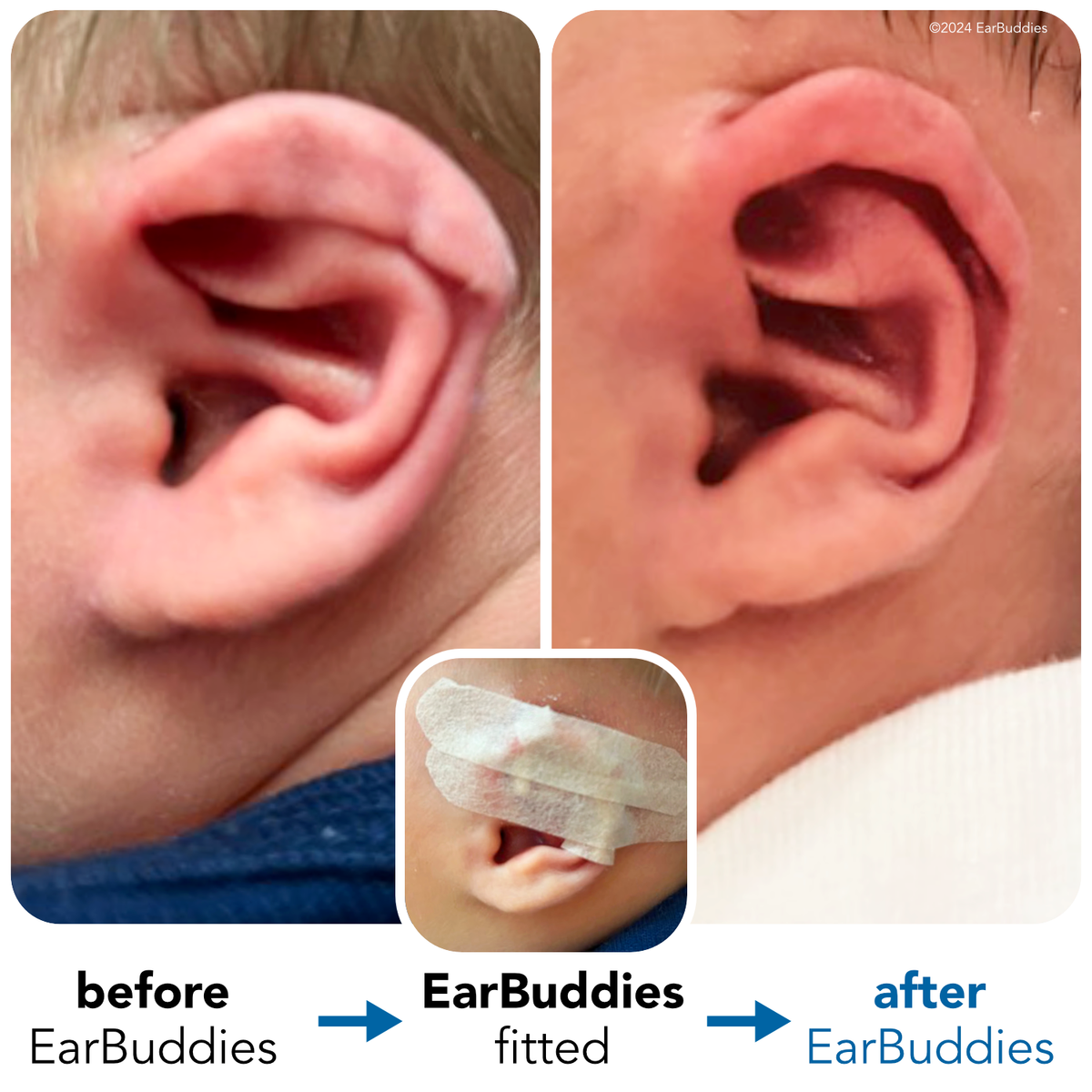 Ear Splints Baby EarBuddies | Permanent Solution to Stick-Out Ears & Ear Deformities