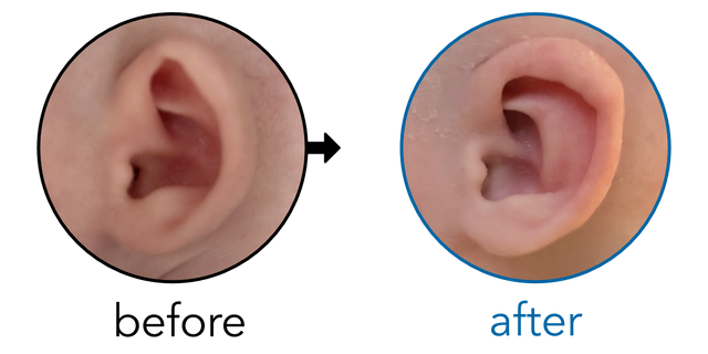 Before-and-after EarBuddies Cup Ear result; started at 1–3 months – Laura & her daughter Erin