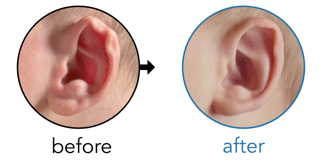 Before-and-after EarBuddies Rim Kink result; started within the first month – Rebecca & her son Rafferty