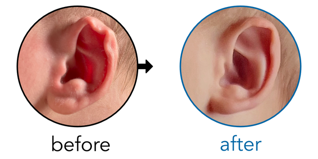 Before-and-after EarBuddies Rim Kink result; started within the first month – Rebecca & her son Rafferty