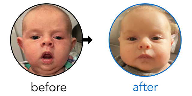 Before-and-after EarBuddies Stick-Out Ears result; started within the first month – Courtney & her daughter Macy
