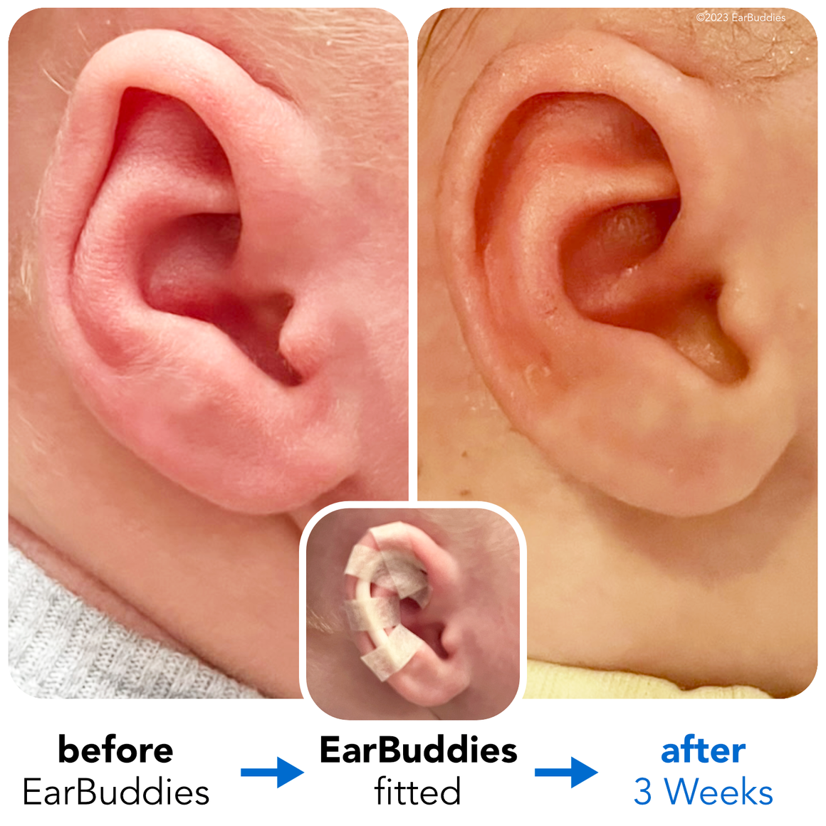 Ear Splints Baby Babys Ears starting to Stick Out or Fold Over? | EarBuddies™