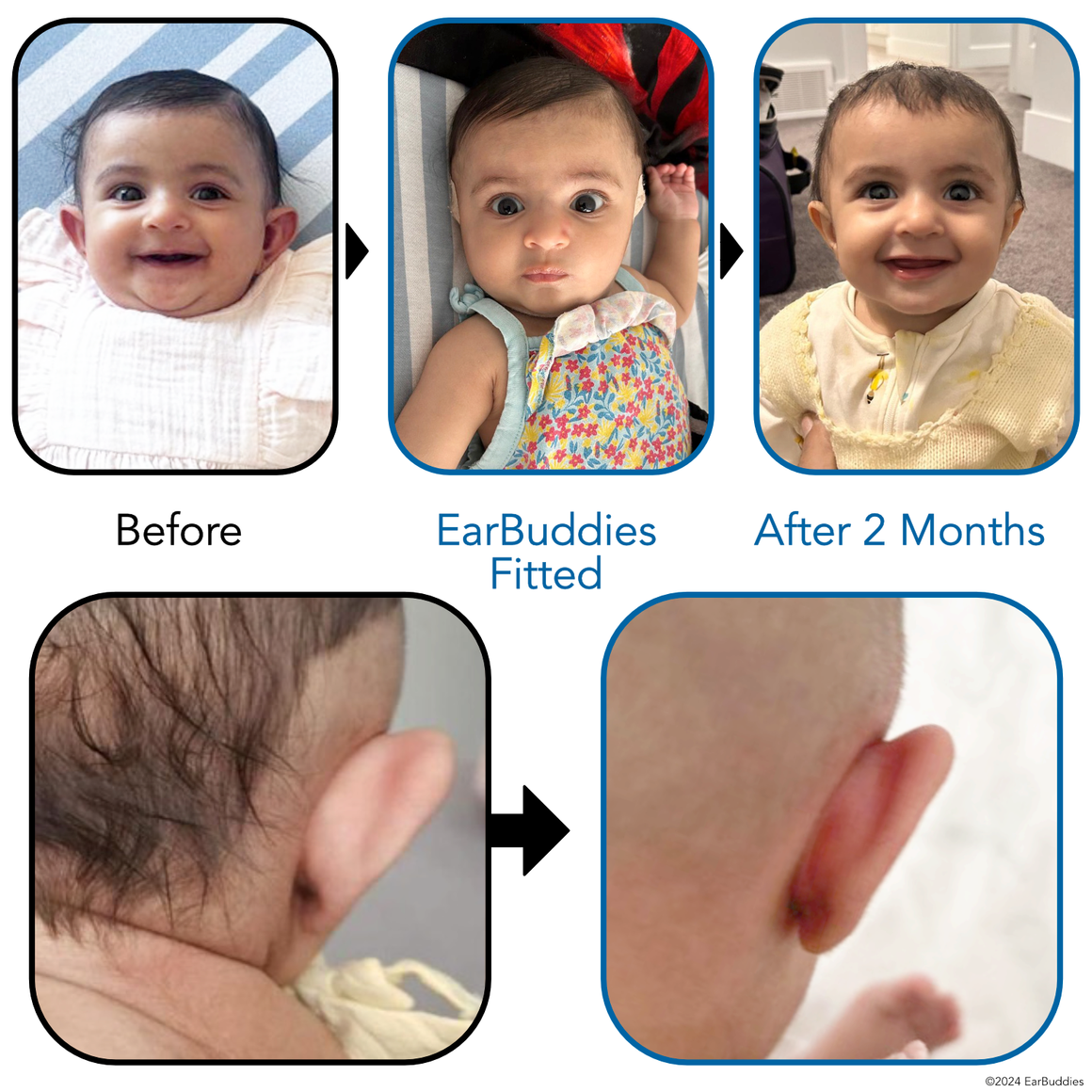 Ear Splints Baby Babys Ears starting to Stick Out or Fold Over? | EarBuddies™