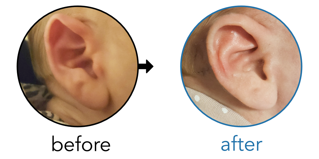 Before-and-after EarBuddies Folded-Over Helical Rim result; started at 1–3 months – Meira & her daughter