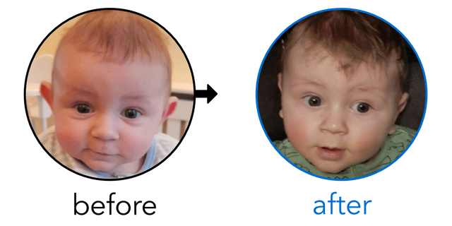 Before-and-after EarBuddies Stick-Out Ears result; started at 1–3 months – Amy & her Son Tyler