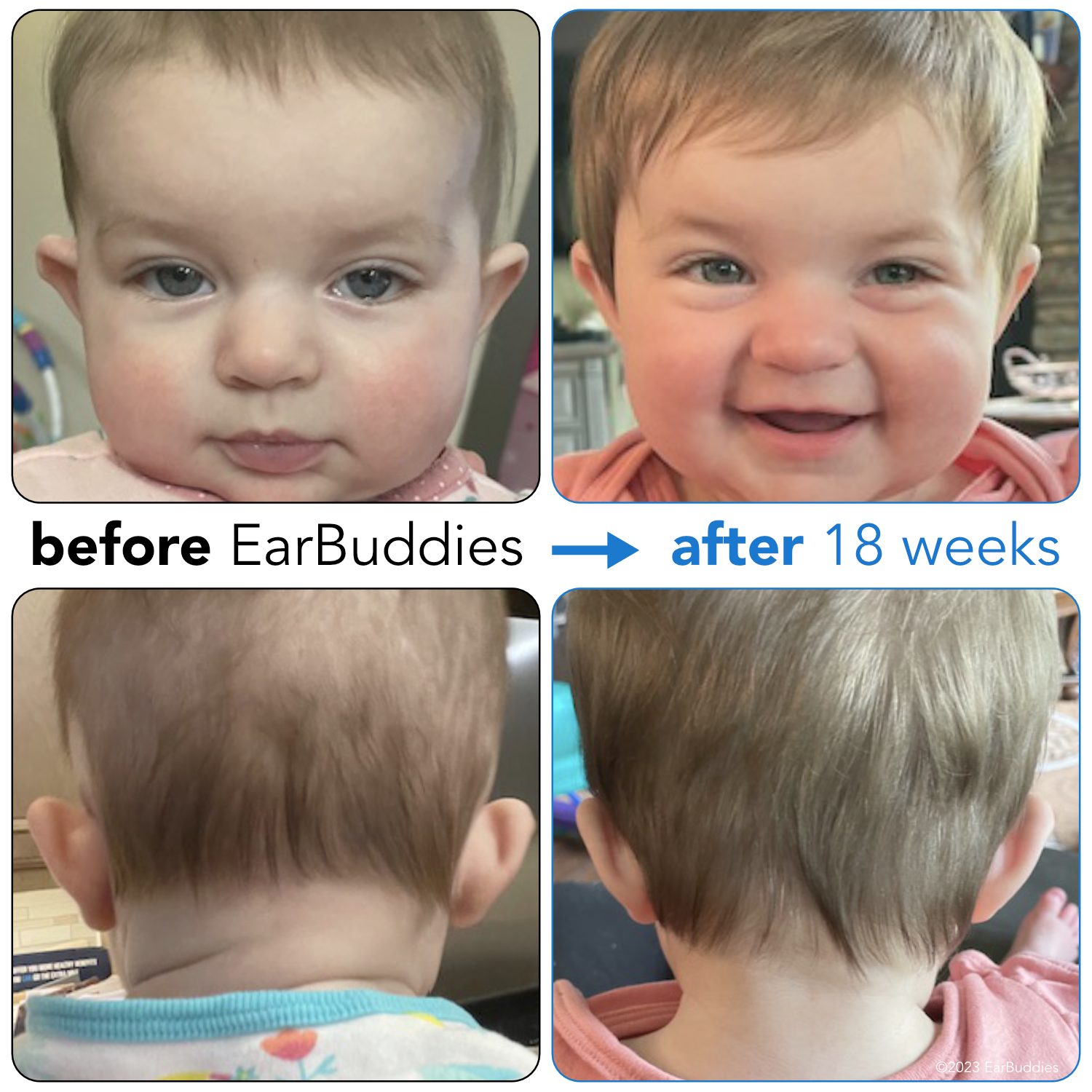 Ear Splints Baby EarBuddies | Permanent Solution to Stick-Out Ears & Ear Deformities