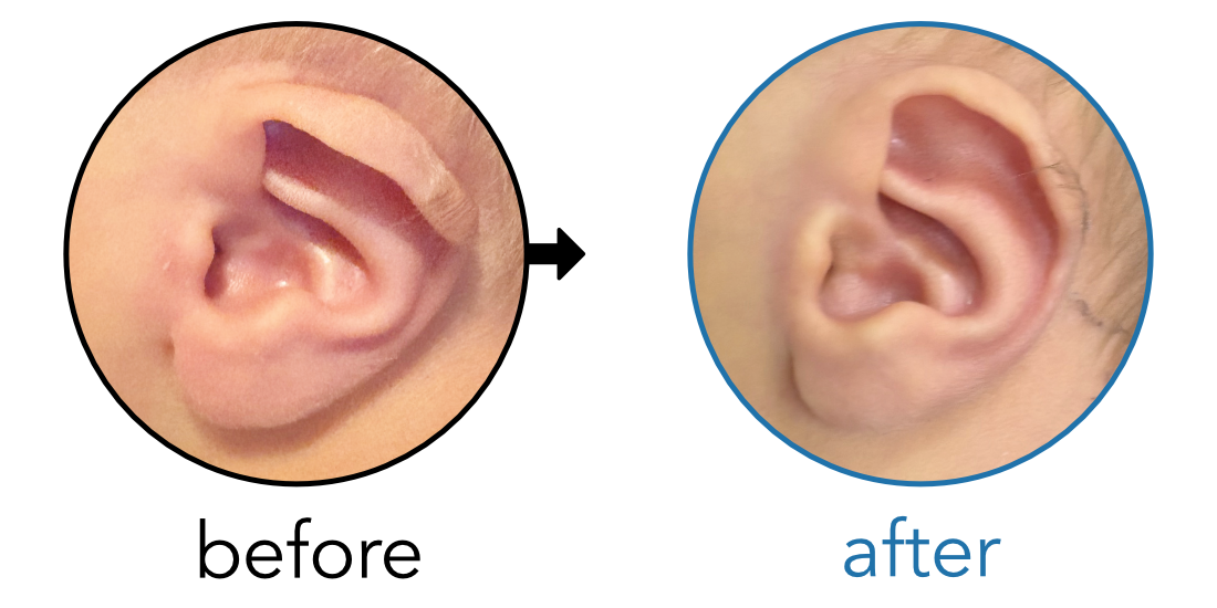 Before-and-after EarBuddies Lop Ear result; started within the first month – Elwyn & his son Emrys