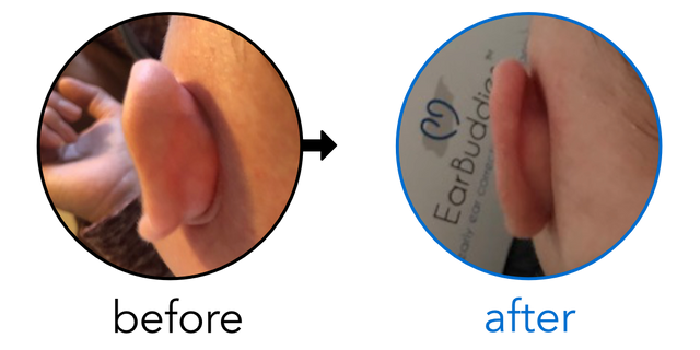 Before-and-after EarBuddies Stick-Out Ears result; started at 1–3 months – Amy & her Son Jacob