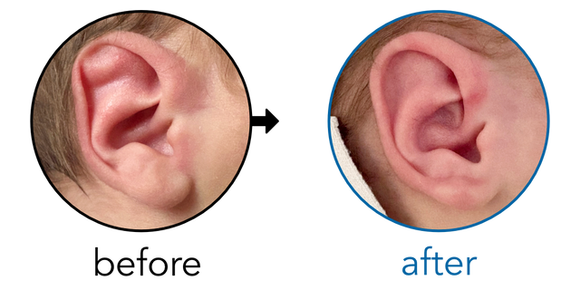 Before-and-after EarBuddies Stahl's Bar result; started within the first month – Gary & his son