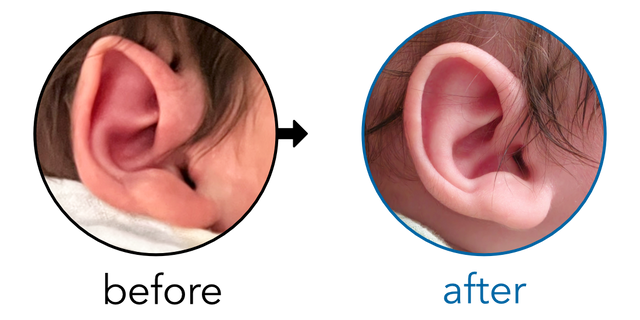 Before-and-after EarBuddies Folded-Over Helical Rim result; started within the first month – Danielle & her son