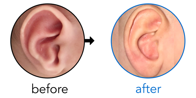 Before-and-after EarBuddies Conchal Crus result; started within the first month – Leora & her son Idan