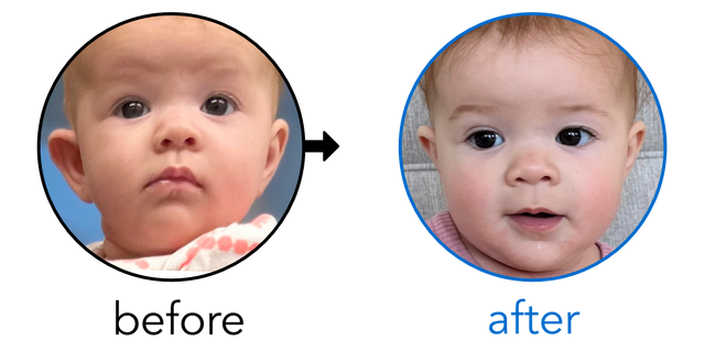 Before-and-after EarBuddies Stick-Out Ears result; started at 3–6 months – Christina & her daughter Ava