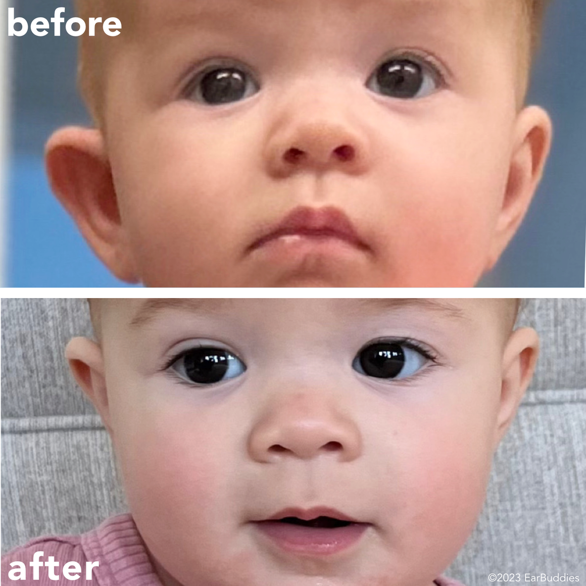 Babys Ears starting to Stick Out or Fold Over? | EarBuddies™