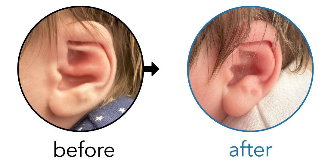Before-and-after EarBuddies Conchal Crus result; started within the first month – Kerry & her son