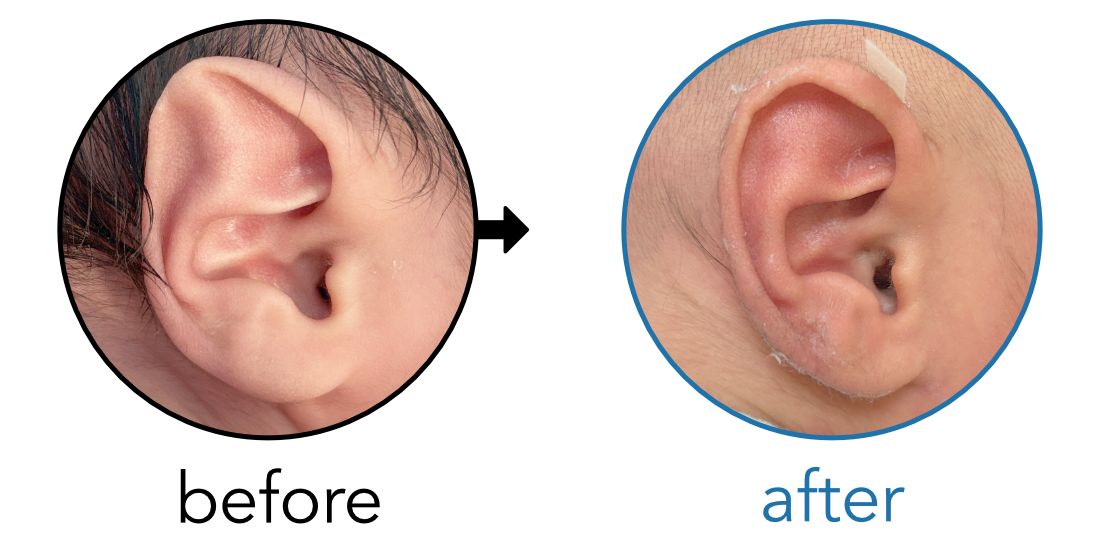 Before-and-after EarBuddies Stahl's Bar result; started within the first month – Keith Leung (Orthotist) & Baby Z