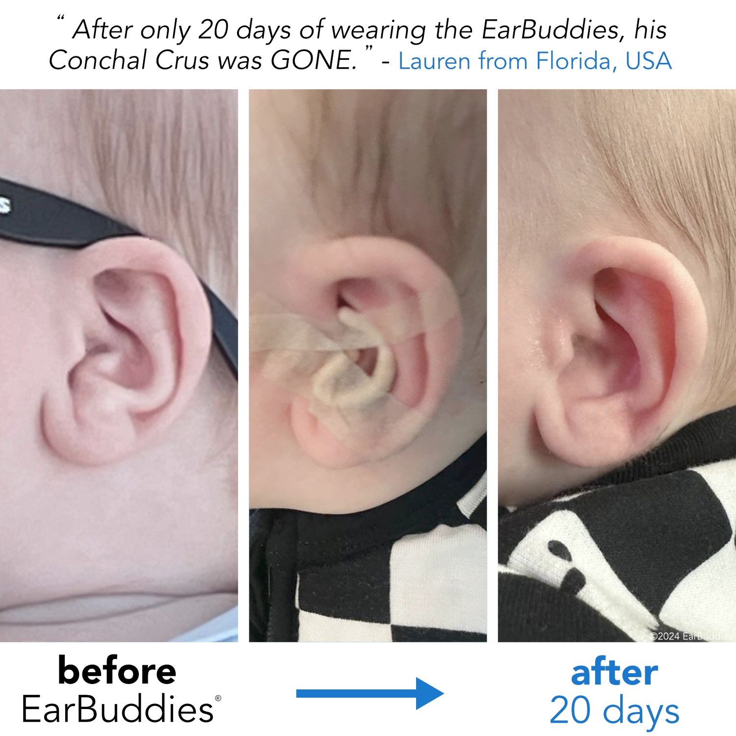 Ear Splints Baby EarBuddies | Permanent Solution to Stick-Out Ears & Ear Deformities