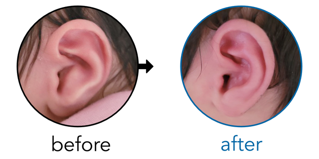 Before-and-after EarBuddies Conchal Crus result; started at 1–3 months – Cassidy & her daughter